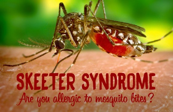 Skeeter Syndrome: Allergies to Mosquito Bites Skeeter Syndrome: Allergies to Mosquito Bites
