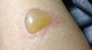 Bug Bites Pictures Slideshow: Identifying Bugs and ... - WebMD