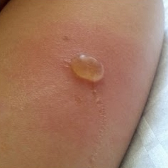 Bug Bites That Blister - LoveToKnow