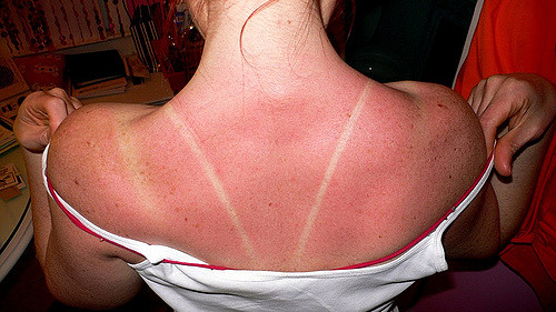 unbearable itchy sunburn