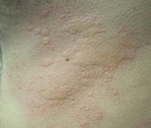 Symptoms of Hives that Come and Go in Adults