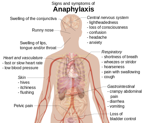 How Long Does Hives Last? Anaphylaxis Signs & Symptoms