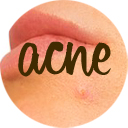 Remedies for Acne Remedies for Acne