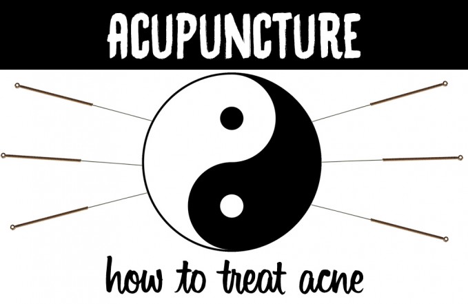 acne acupuncture treatment