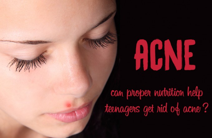 acne diet teenagers