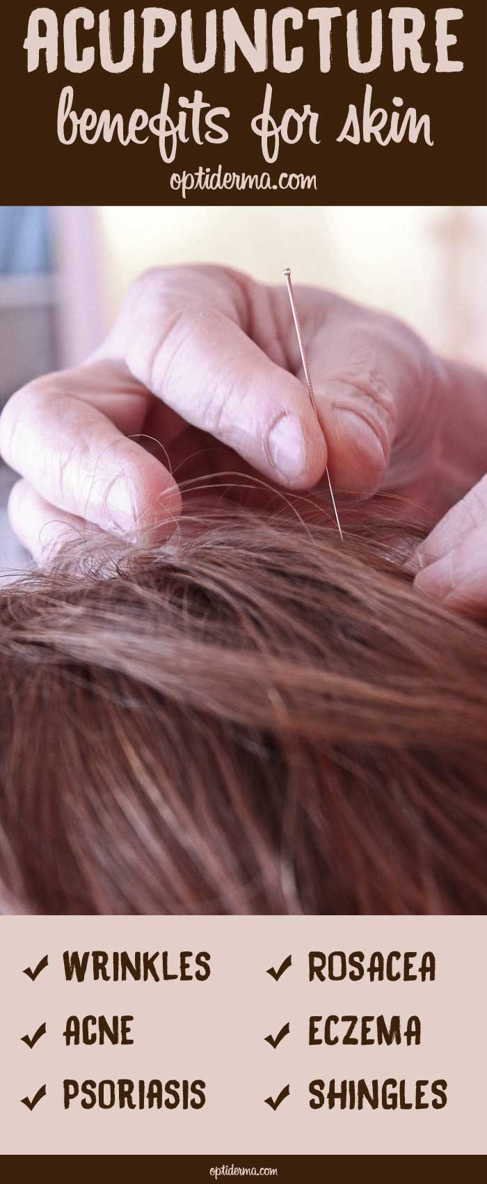 Benefits of acupuncture for skin