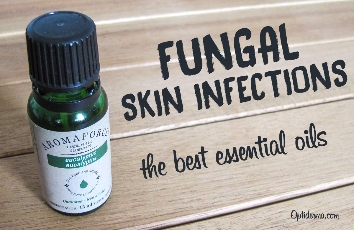 Top 5 Antifungal Essential Oils for Skin, Scalp and Nails