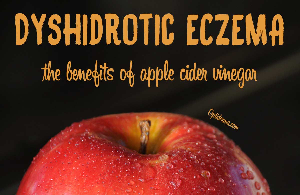 Apple Cider Vinegar for Dyshidrotic Eczema - Home Remedies