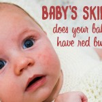 Baby's skin: red spots, bumps, heat rash, eczema