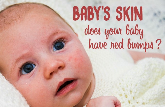 Baby's skin: red spots, bumps, heat rash, eczema