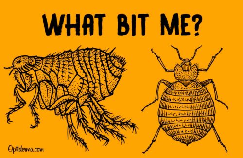 Bed Bug Bites vs Flea Bites - What Bit Me ? Bed Bug Bites vs Flea Bites - What Bit Me ?