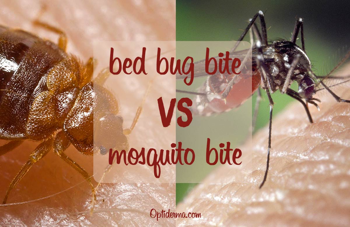 Bed Bug Bites vs Mosquito Bites