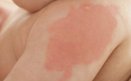 How to get rid of birthmarks - baby skin