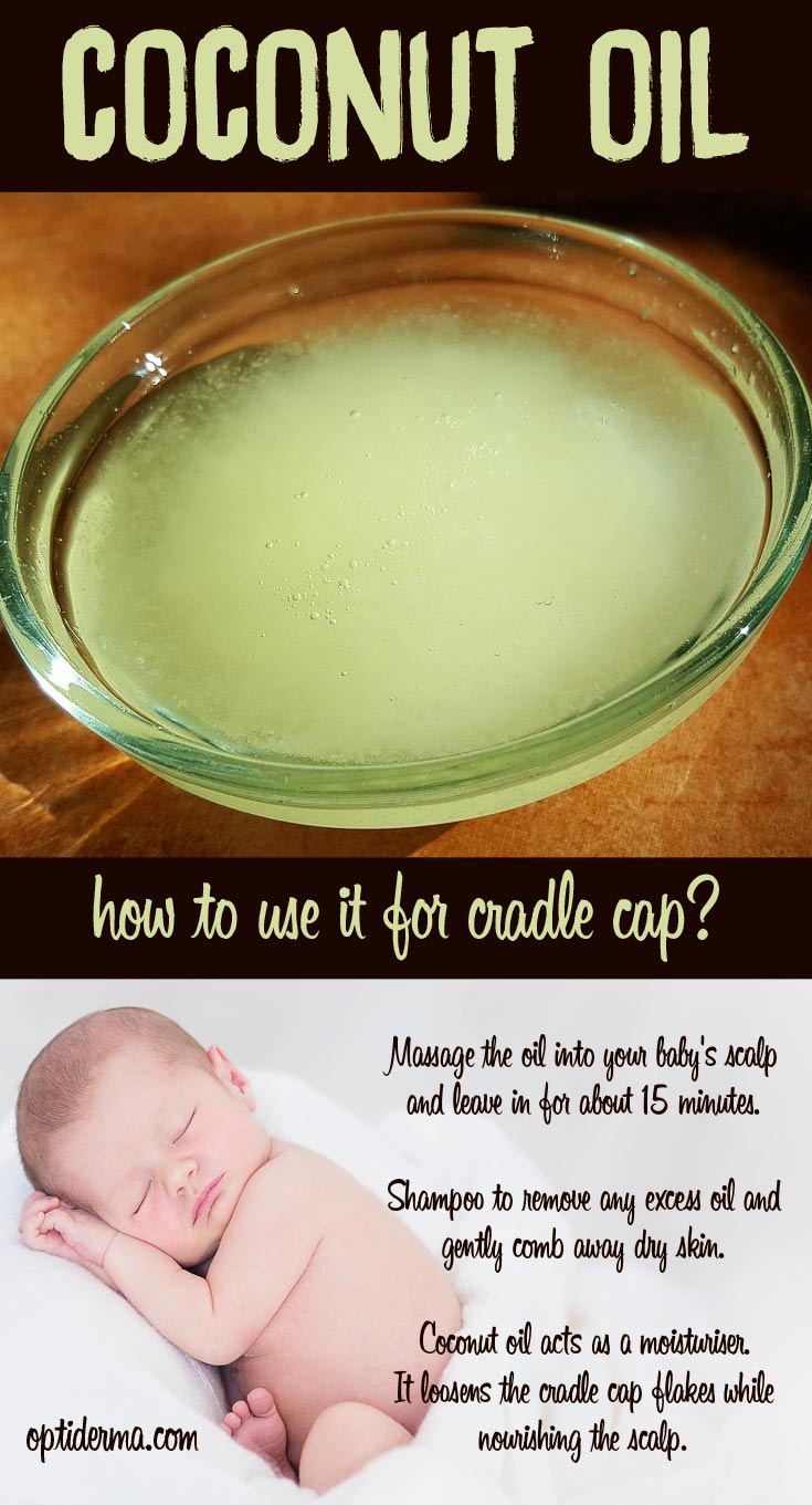 breast milk for cradle cap