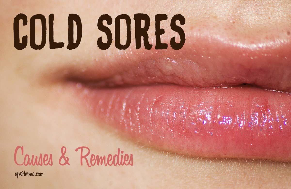 Cold Sores: Causes & Remedies