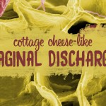 cottage cheese vaginal discharge