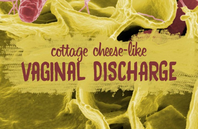 cottage cheese vaginal discharge