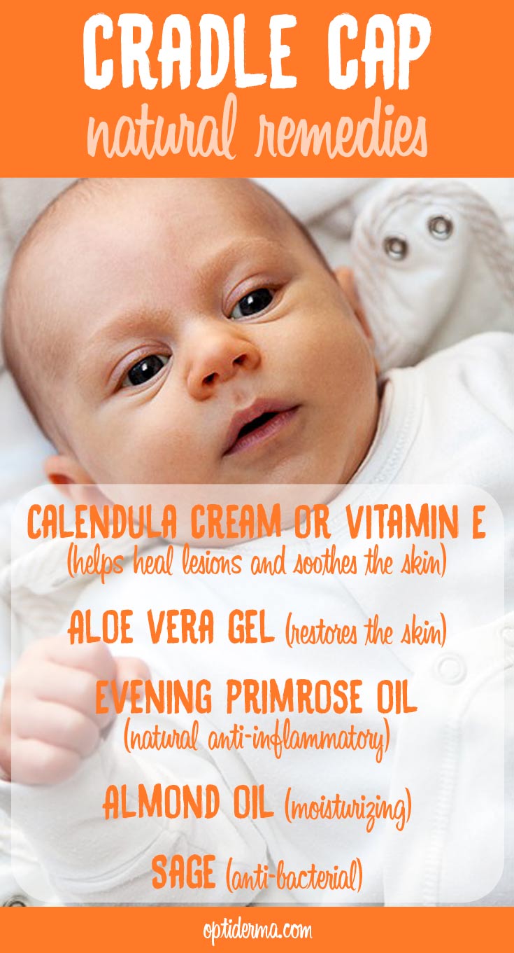 Natural Remedies for Cradle Cap