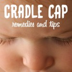 How to treat cradle cap