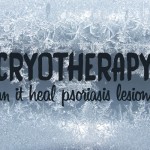 cryotherapy for psoriasis