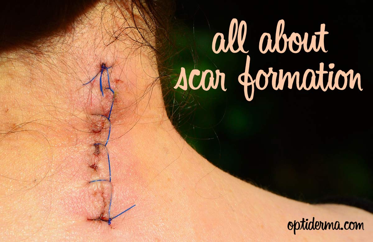 So All Cuts Scar?