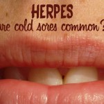 Do most people get cold sores?