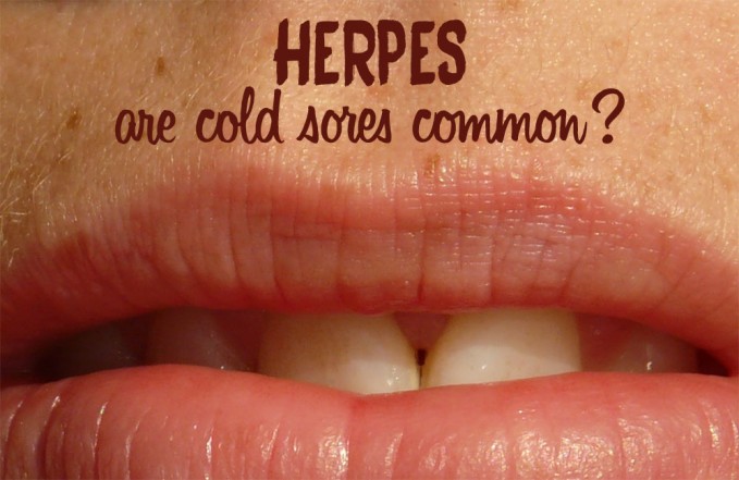 Do most people get cold sores?