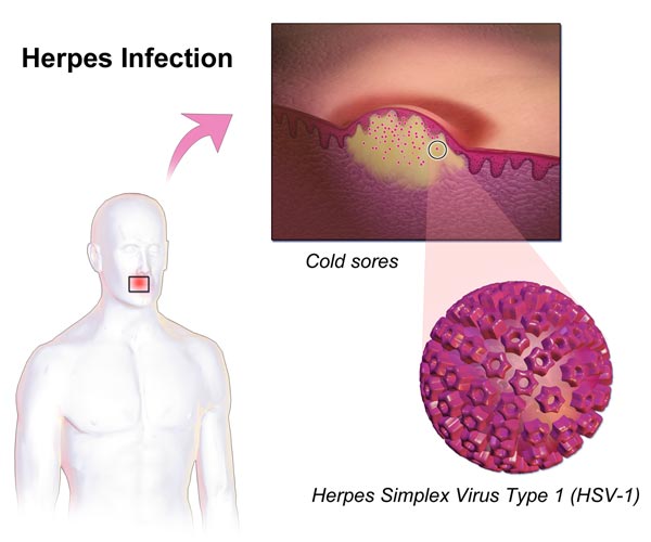 Fever Blister Virus