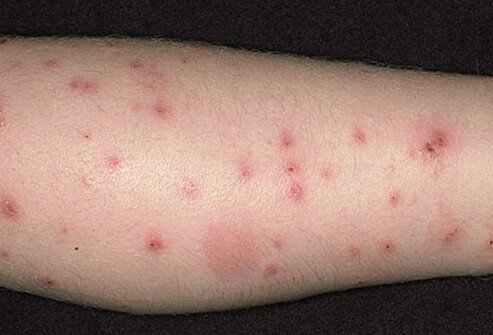 flea bites vs bed bug bites