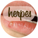 Remedies for Herpes Remedies for Herpes