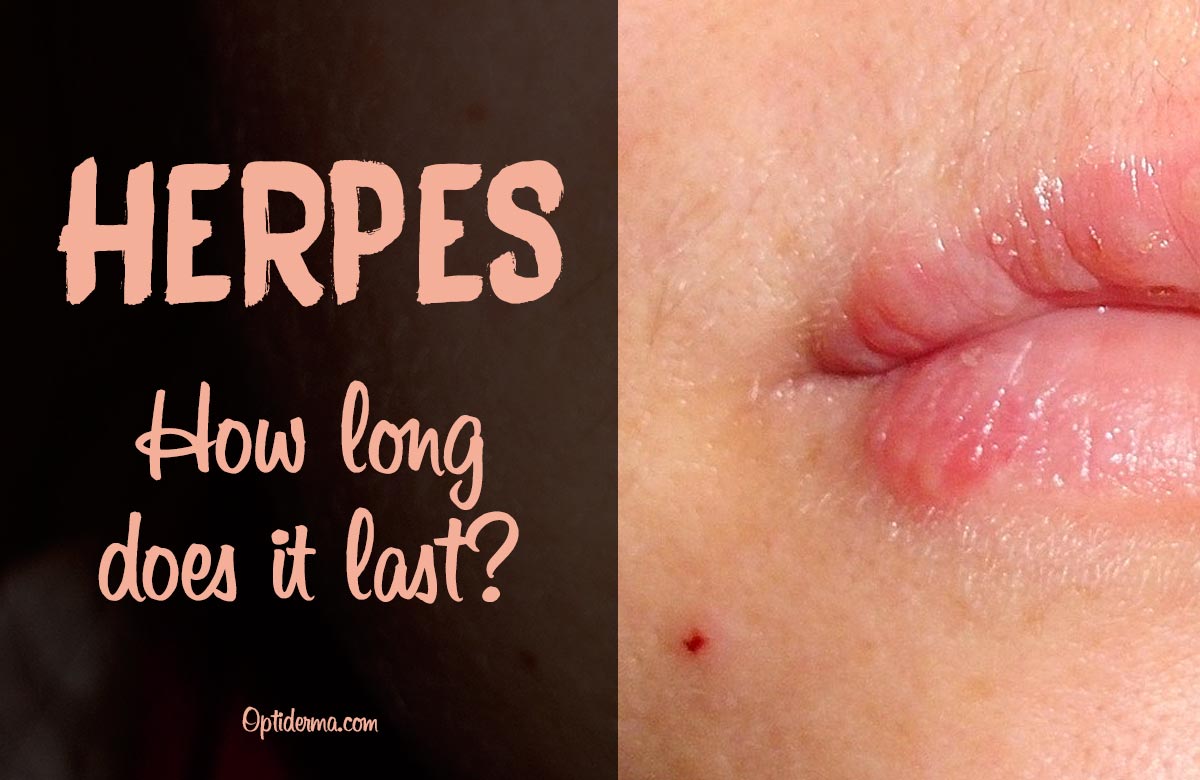 How Long Does a Herpes Outbreak Last?
