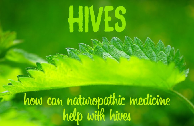 hives urticaria naturopathy