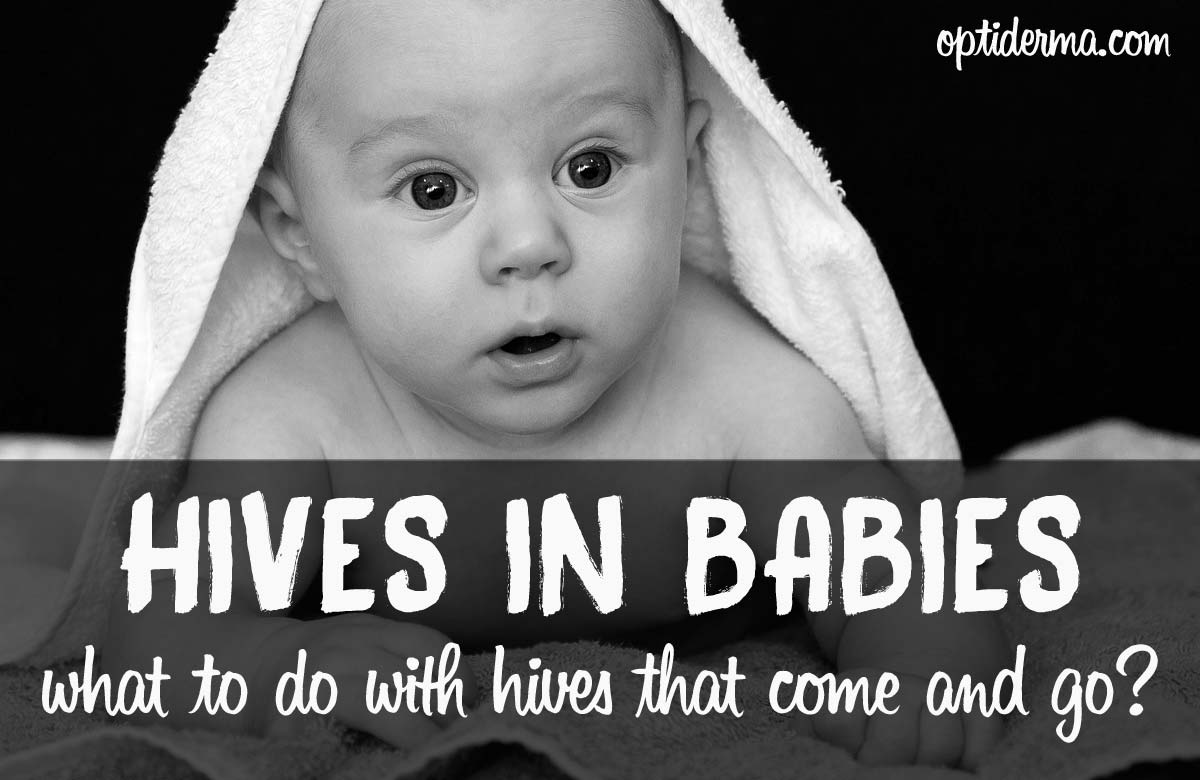 Hives that Come and Go in Babies