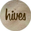 Natural Remedies for Hives Natural Remedies for Hives