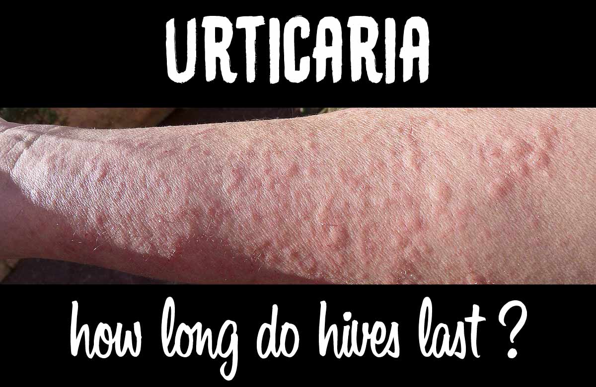 How Long Do Hives Last After an Allergic Reaction?