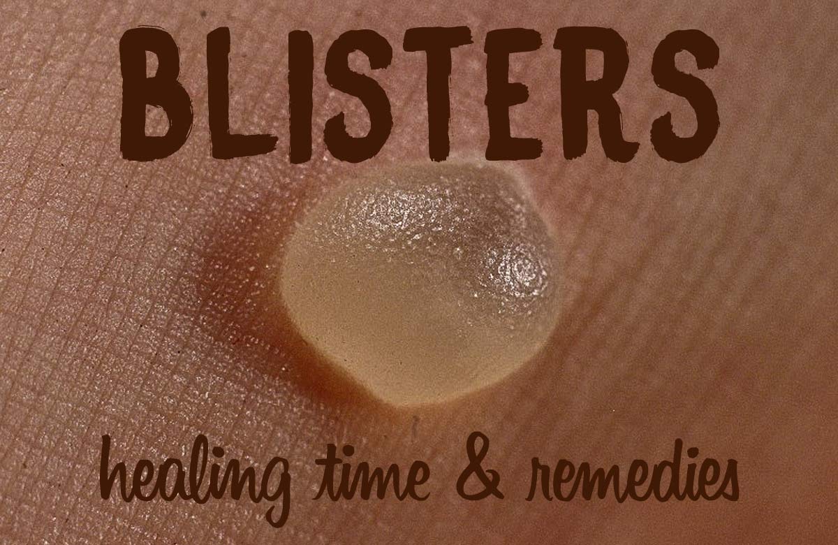 How Long Does it Take for a Blister to Heal? Blister Healing Time