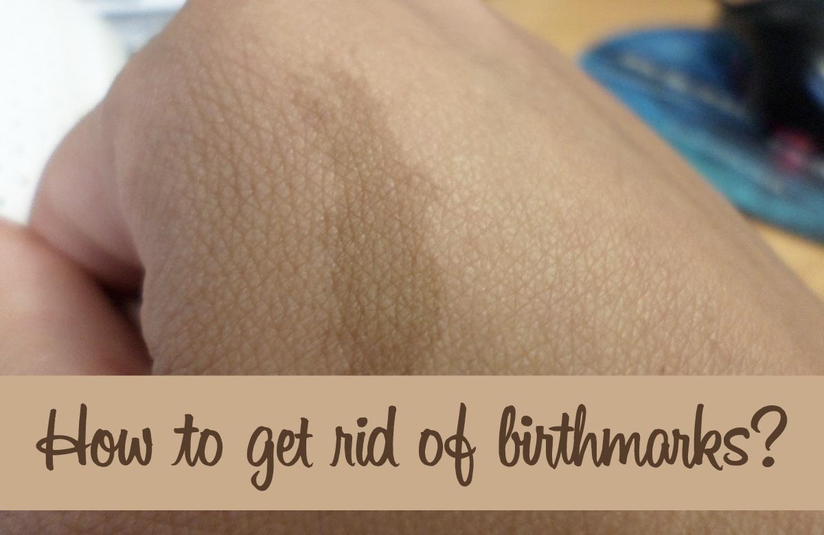 Birthmark Removal - How to Get Rid of Birthmarks?