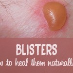 How to Heal Blisters Fast with Aloe Vera, Castor Oil & Calendula for Blisters