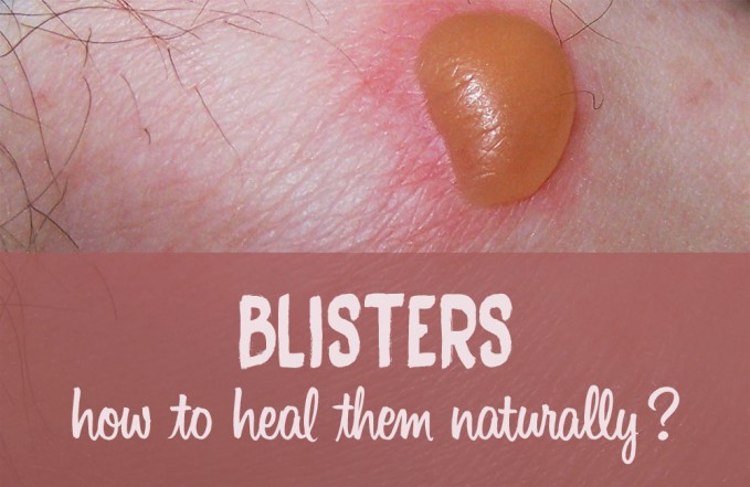 How to Heal Blisters Fast with Aloe Vera, Castor Oil & Calendula for Blisters