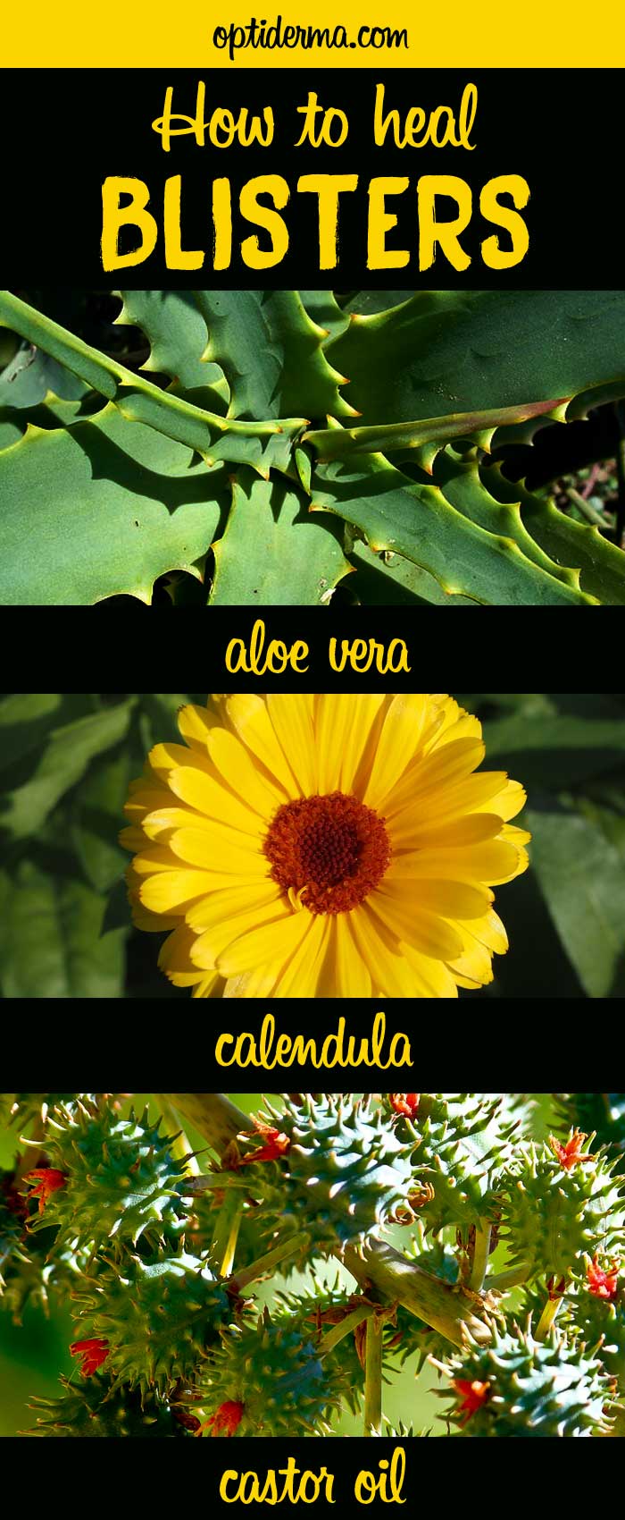 How to Heal Blisters with Calendula, Aloe Vera or Castor Oil