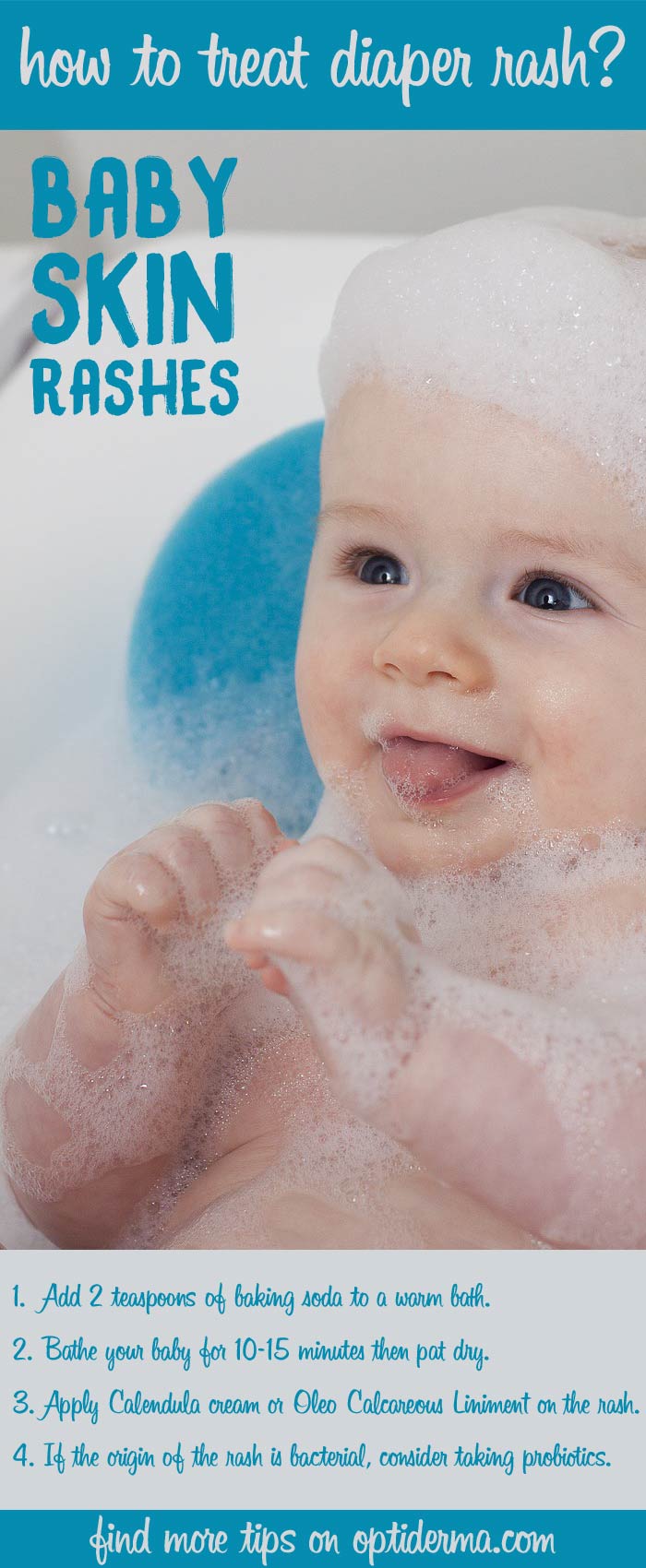 How to Treat Diaper Rash in Babies?