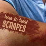 How to treat scrapes