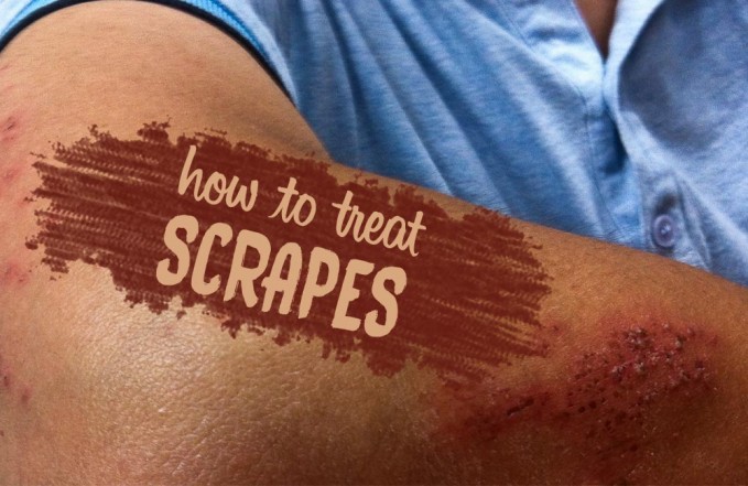 How to treat scrapes