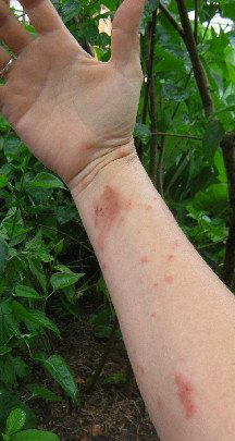 Itchy Rash Poison Ivy