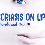 Psoriasis on lips