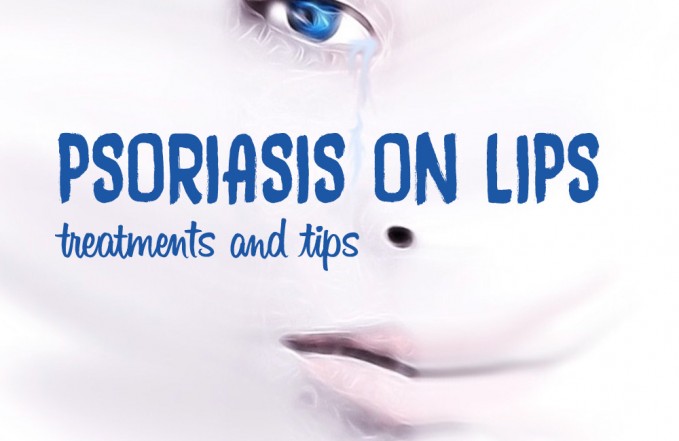 Psoriasis on lips