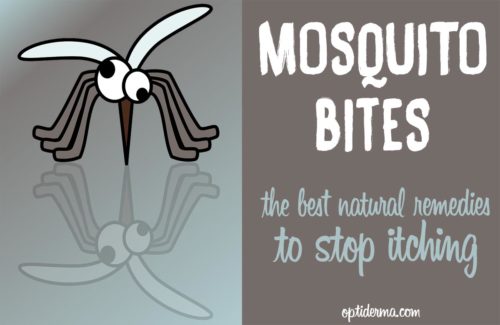 Best remedies to stop mosquito bite itch