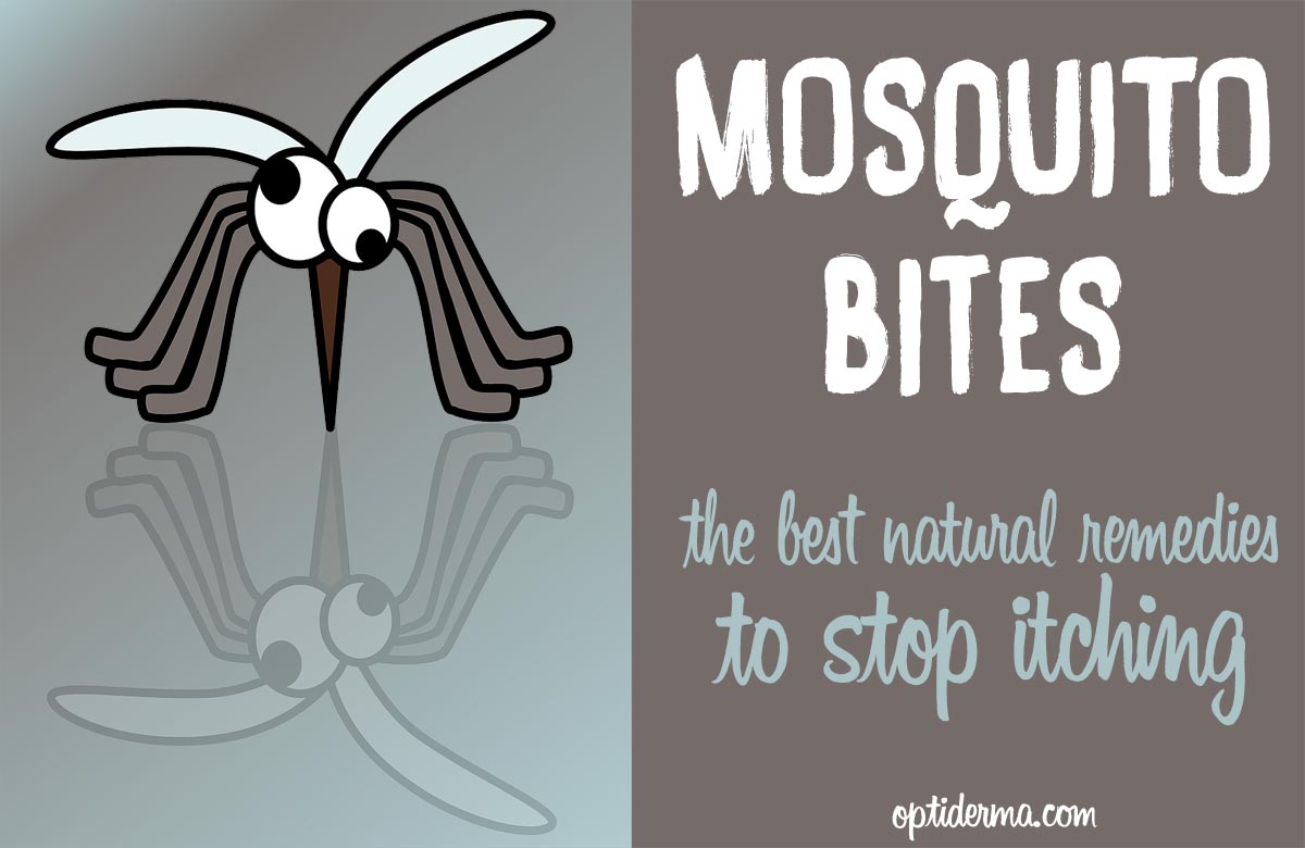 Best remedies to stop mosquito bite itch