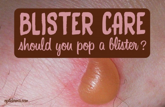 Blister care: should you pop a blister?