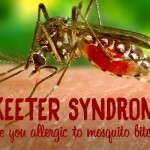skeeter syndrome